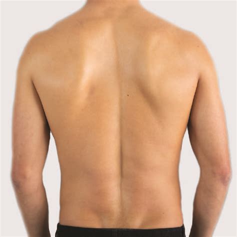 full  shoulders neck results laser clinic