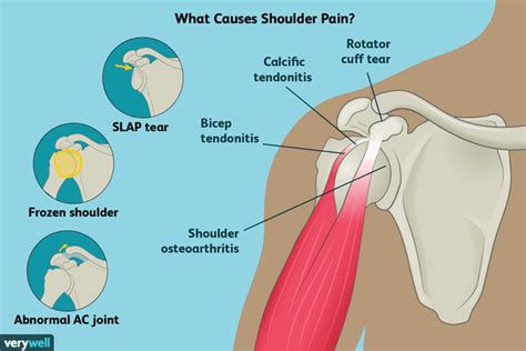Shoulder Pain Causes Treatment And When To See A Healthcare Provider