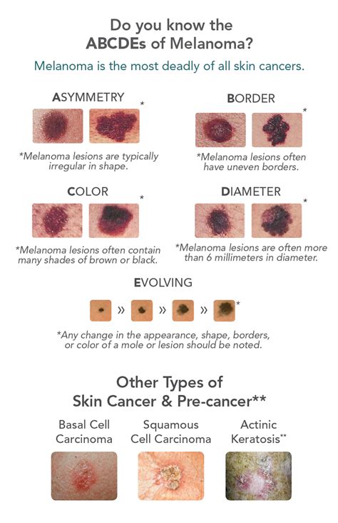 What Are The Signs And Symptoms Of Melanoma Skin Cancer Melanoma