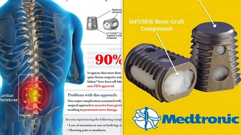 Medtronic Infuse Bone Graft Used In Spine Surgery In