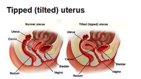 Retroverted Uterus Tilted Uterus Cause Symptoms