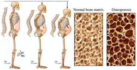 osteoporosis causes risk factors and treatment symptoms medications