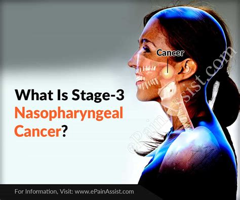 What Is Stage 3 Nasopharyngeal Cancer