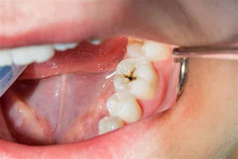 gaatjes  kiezen herkennen keizer karelpark tandartsen