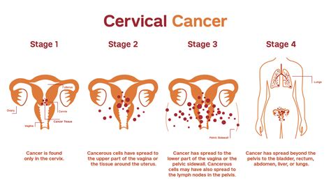 Treatment Of Cervical Cancer Best Homeopathy Doctor In India Us