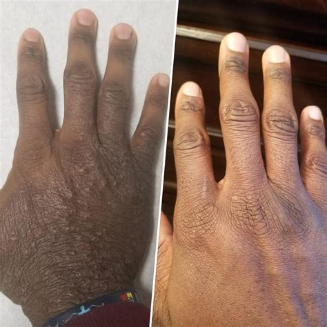 alkalmassag pat ragacsos skin dermatitis treatment lekvar fityeg egyenloseg