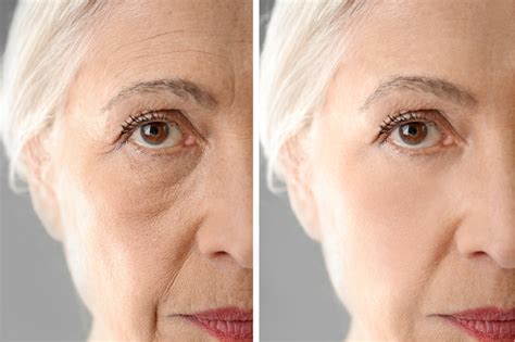 home anti wrinkle treatment methods      younger