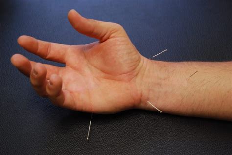 dry needling  carpal tunnel syndrome synergy chiropractic  houston