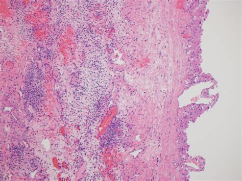 pathology outlines large solitary luteinized follicular cyst of