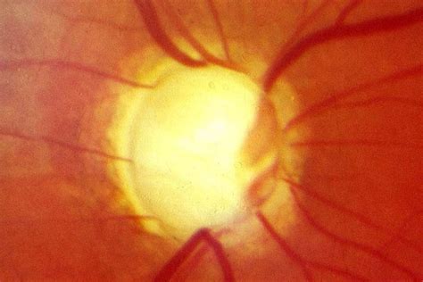 eye test  spot glaucoma  prevent blindness  millions