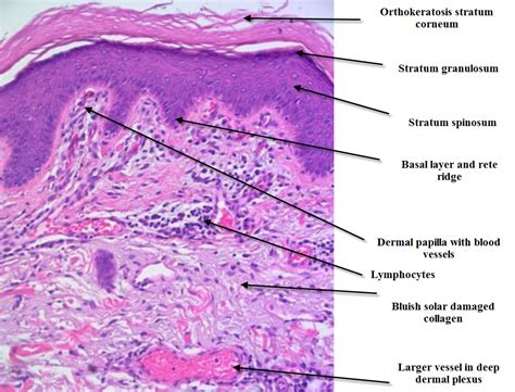 dermatopathology  simple inflammatory introduction  skin histopathology