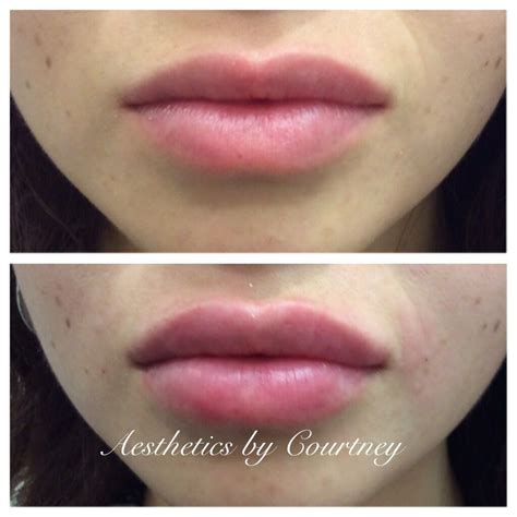 pin by lip fillers collective on lip fillers lip fillers lip