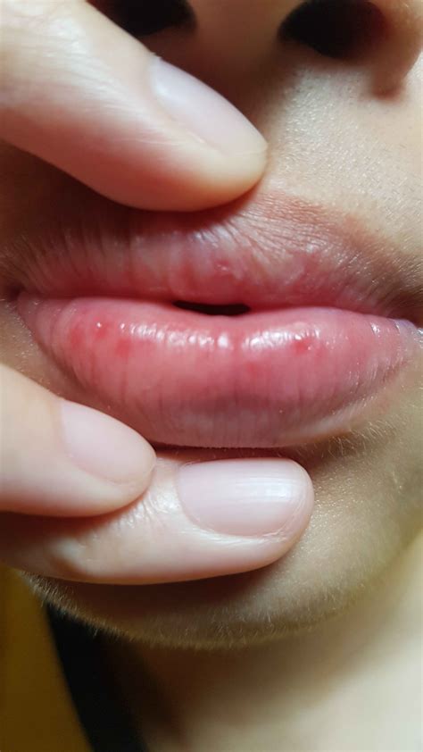how can i tell that the bumps on my lips are a rash or hsv or something
