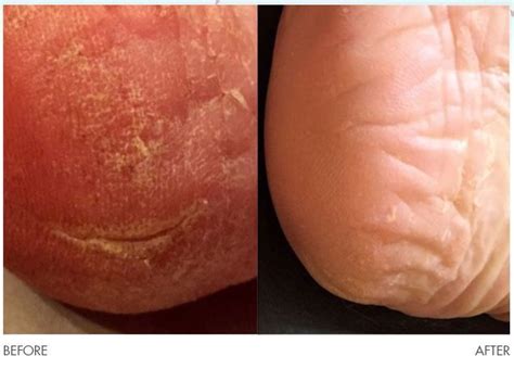 dry cracked skin check   amazing results    skin supplement