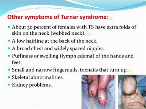 best 16 turner syndrome images on pinterest turner syndrome ap biology and biology