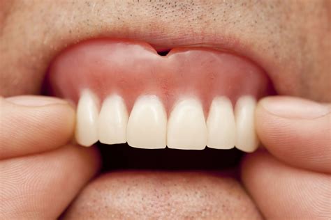dentures  periodontal health skillman nj  dentures affect p