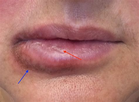 recurrent blisters   lip  bmj