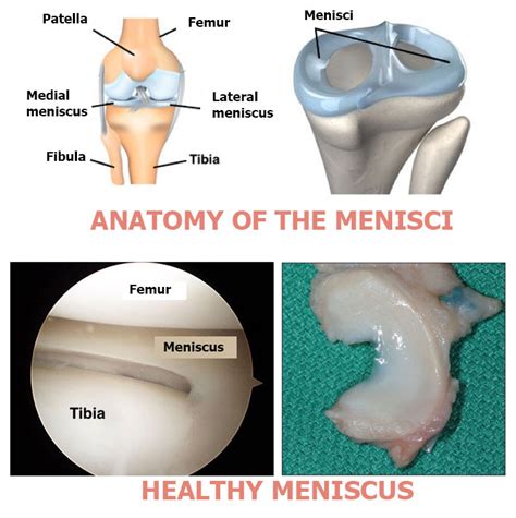 meniscus tear docteur bruno levy