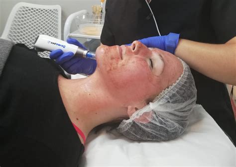 dermapen microneedling treatments cape town and somerset west