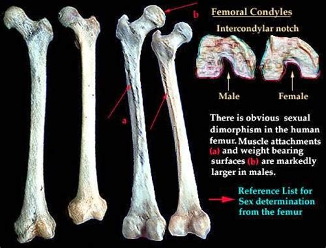 Determining Sex By Using The Femur Forensicpedia