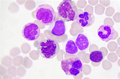 higher total cholesterol  ldl  levels    wbc