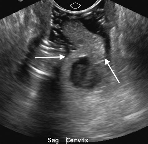invited commentary on “us of the nongravid cervix with multimodality