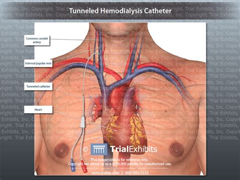 Tunneled Hemodialysis Catheter Trial Exhibits Inc