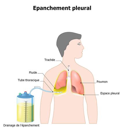 Activation équilibre La Toile Cancer Du Poumon Liquide Pleural La