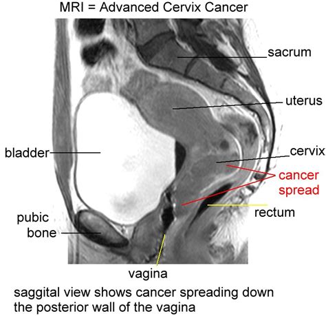 gynecologic cancer images