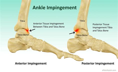 ankle impingementsymptomscausestreatmentrecovery period