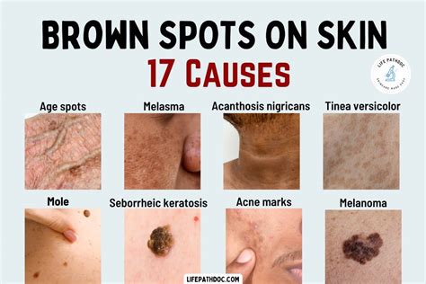 brown spots  skin   pictures treatment