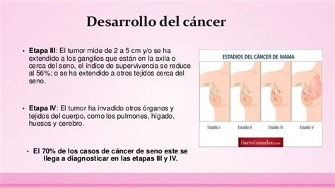 cancer de mama