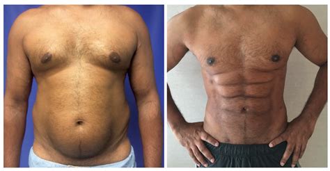 this plastic surgery procedure that promises to give you six pack abs