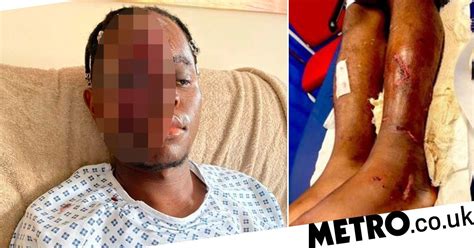 nhs worker lucky to be alive after racists deliberately drove car