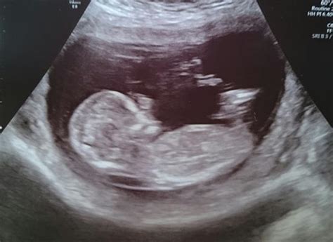 13 Weeks 5 Days Nub Prediction Please In Ultrasound Gender