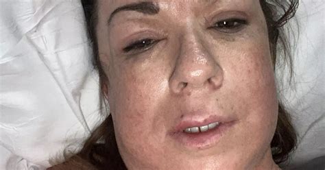 Mum Gets Lip Filler To Cheer Herself Up But Ends Up Almost Dying
