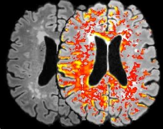 kun je op een hersenscan zien wat je hoort medicalfactsnl