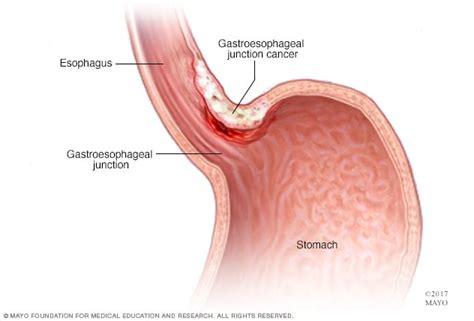 Stomach Cancer Symptoms And Causes Mayo Clinic