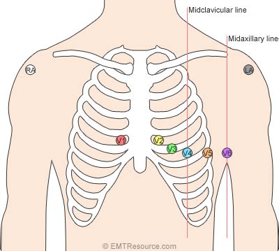 lead ecg placement