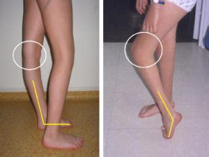 flexion deformity   knee physiopedia