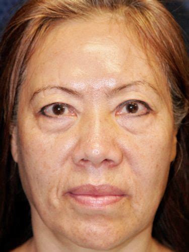 facelift 13 before and after photos pasadena and los angeles thomas taylor m d