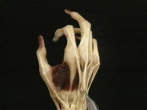 long extrinsic finger extensor muscles acland s video