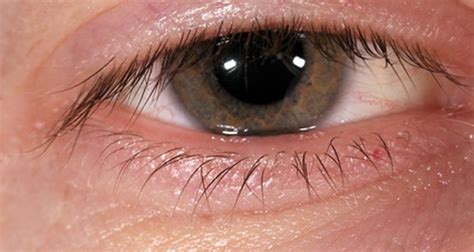 What Causes Cornea Swelling After Cataract Surgery