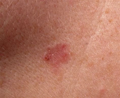 the warning signs of skin cancer daily star
