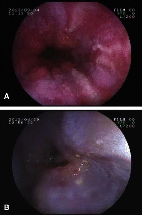 Dysphagia Concise Medical Knowledge