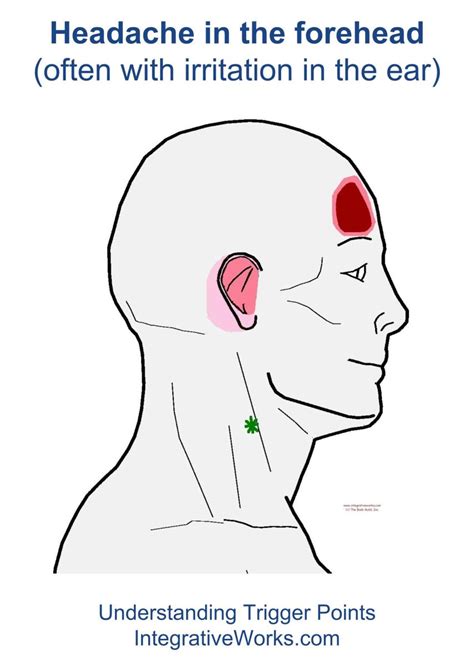 trigger points headache   forehead integrative works