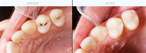 dental fillings  dr whitney sebree surprise arizona