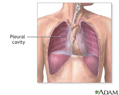 pleural effusion information mount sinai  york