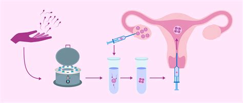 process  ivf  donor sperm