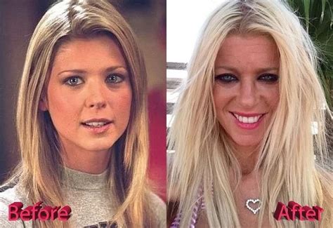 6 Botched Cosmetic Surgeries That Ruined Beauty Of Famous